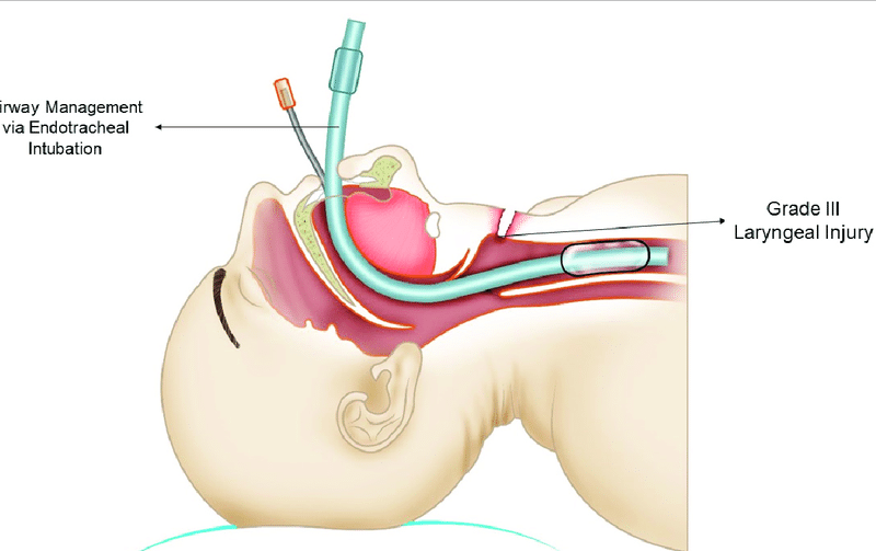 Airway Management