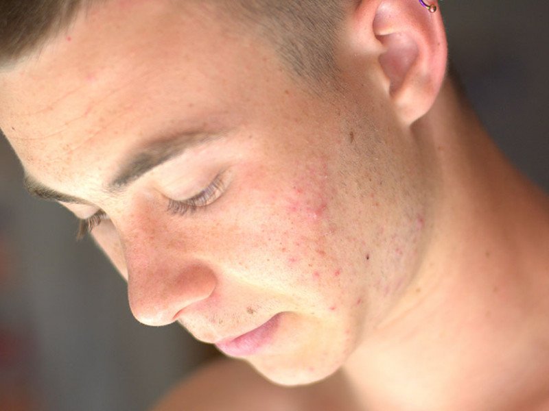 Retin-A cream for Treating Acne