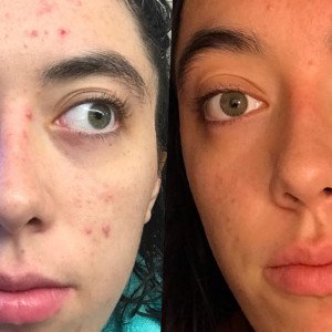 Benefits, Uses and Side Effects of Tretinoin