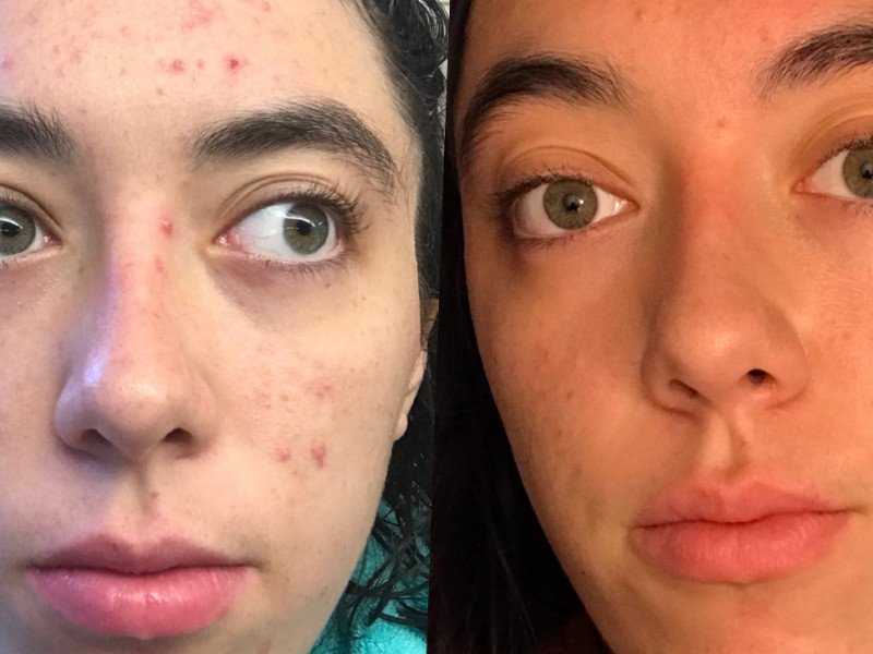 Benefits, Uses and Side Effects of Tretinoin