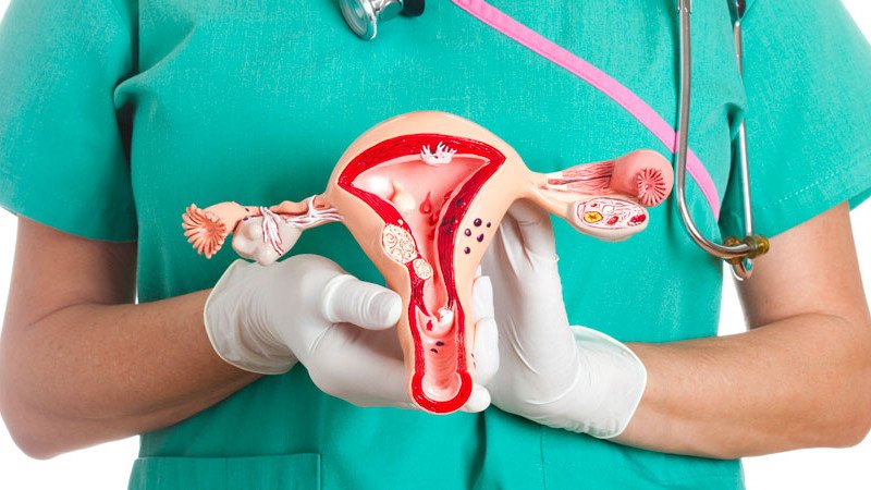 ovarian_cancer